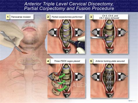 Anterior Triple Level Cervical Discectomy Partial Corpectomy and...