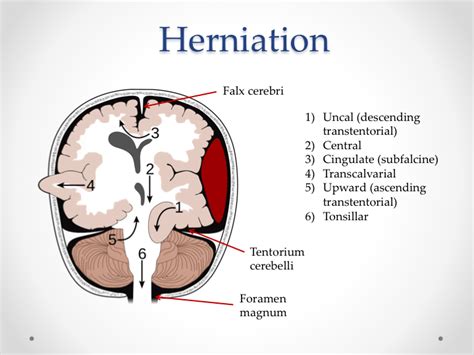 Brain Herniation 2 - Charlie's ED