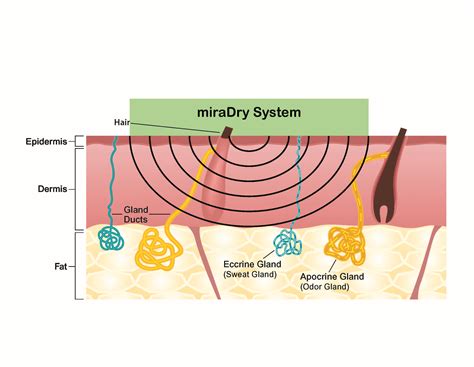 miraDry System | Krauss Dermatology