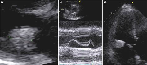 Mitral annular calcification measuring 1.7 × 1.9 cm extending the ...