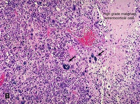 American Urological Association - Adrenocortical Carcinoma