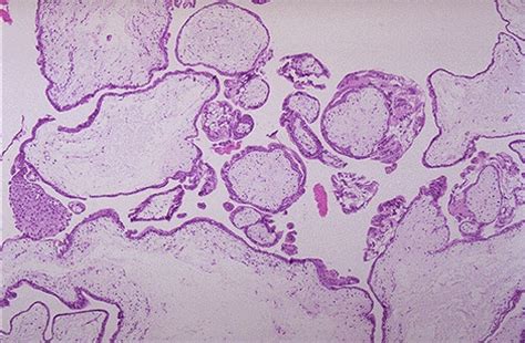 hydatidiform mole placenta histology