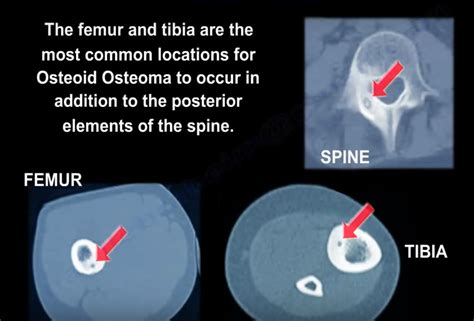 Osteoid Osteoma: Clinical Features and Management ...