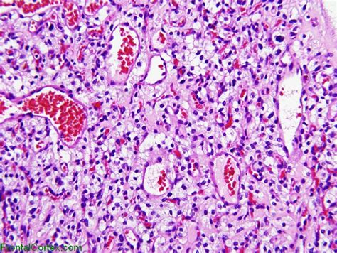 Hemangioblastoma, H&E stain x 200