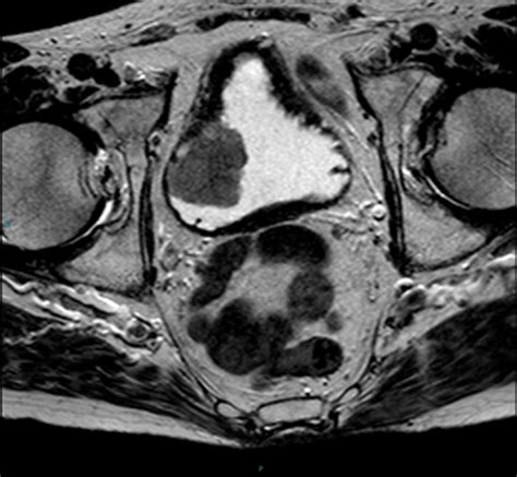 Bladder carcinoma MRI | Urology News