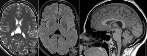 Radiology MRI: Cavum Velum Interpositum on MRI