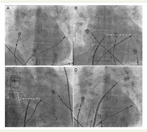 Figure 1 from The training and learning process of transseptal puncture using a modified ...