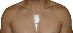 how to where novi Patch Holter Monitor | Holter monitor, Medical, Monitor