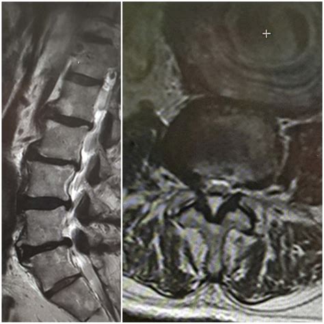 Lumbar Spine MRI: (A) sagittal T2WI showing degenerative disc changes ...