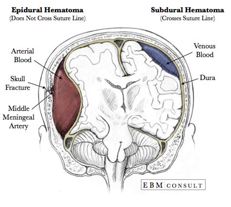 Epidural Hematoma Middle Meningeal Artery