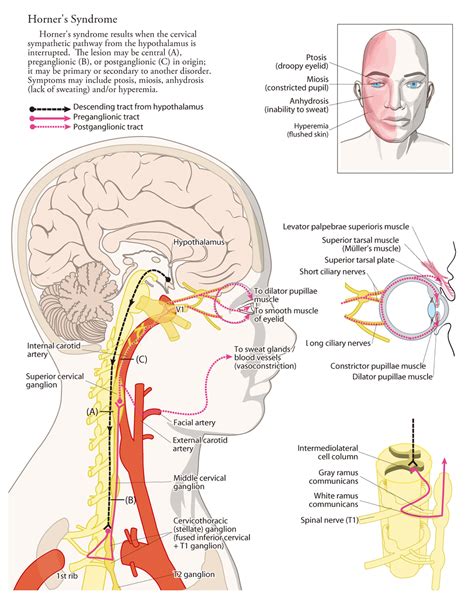 Horner's Syndrome - Causes, Signs & Symptoms, Diagnosis, Treatment