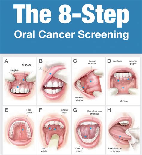 Oral Cancer Screenings – Exton Family Dentist