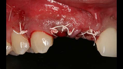 How to suture after bone grafting with membranes? - YouTube