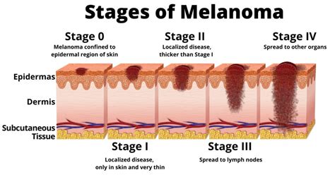 Melanoma Risk Factors - RX Adviser