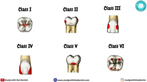 Classification Of Dental Caries Classification Of Dental Caries | The Best Porn Website