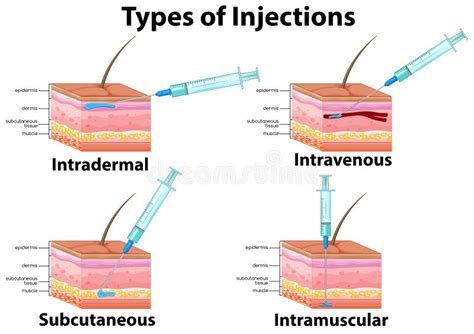 Un Sistema De Tipo De Inyecciones Ilustración del Vector - Ilustración ...