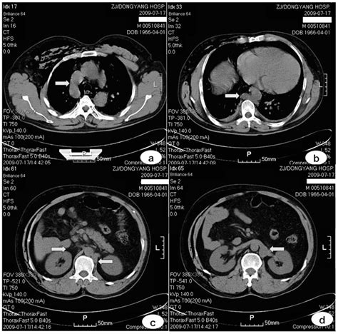 Plain scanning: (a) the clearly-thickened azygos vein (arrow) arches... | Download Scientific ...