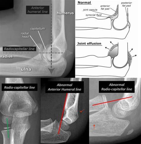 Olecranon Fossa X Ray