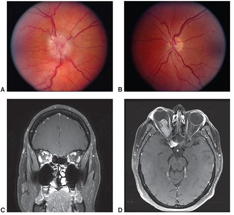 Optic nerve sheath meningioma - American Academy of Ophthalmology