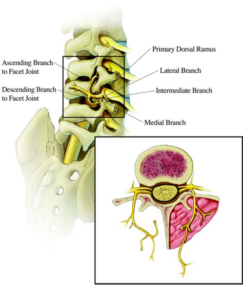 Lumbar Facet Syndrome | Market tay