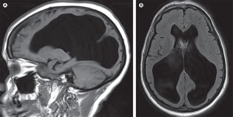 Compensated hydrocephalus - The Lancet