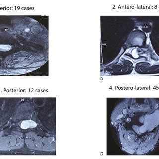 Axial location of the spinal cord tumor as observed in MRI scans ...