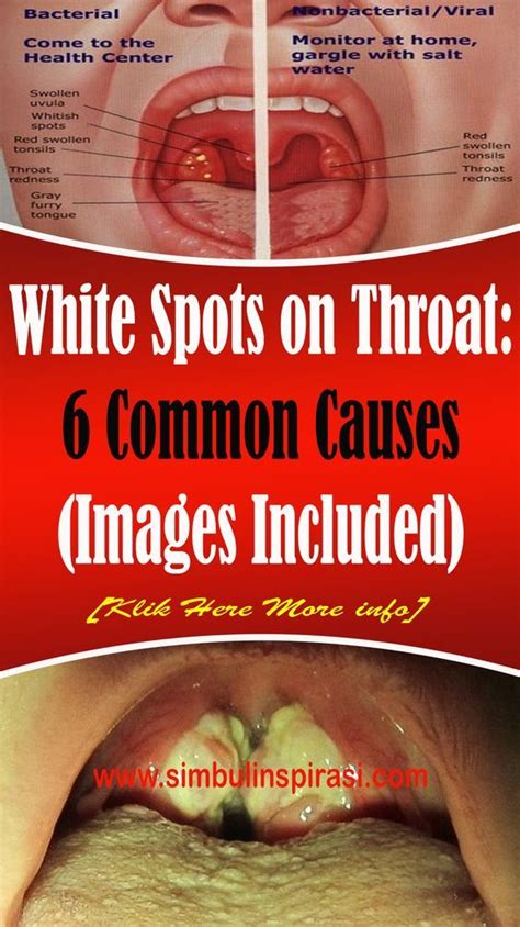 Throat White Spots On Tonsils