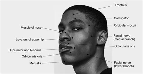 Motor points of face for electrical stimulation of bell's palsy ...