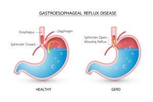 Gastroesophageal Reflux Disease | Association of South Bay Surgeons