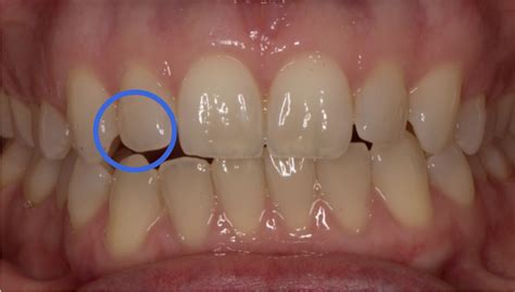 Splint for anterior open-bite distortion | Elizabeth Caughey ...