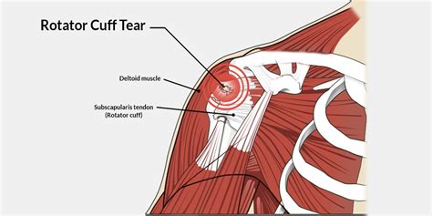 Rotator Cuff Tear Anatomy | Porn Sex Picture