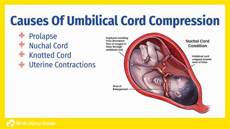 Umbilical Cord Compression and Your Baby's Health | Birth Injury Guide