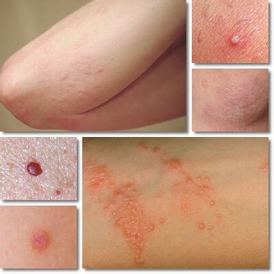 Red Bumps on Arms: Causes, Symptoms and Treatment - NatureWord