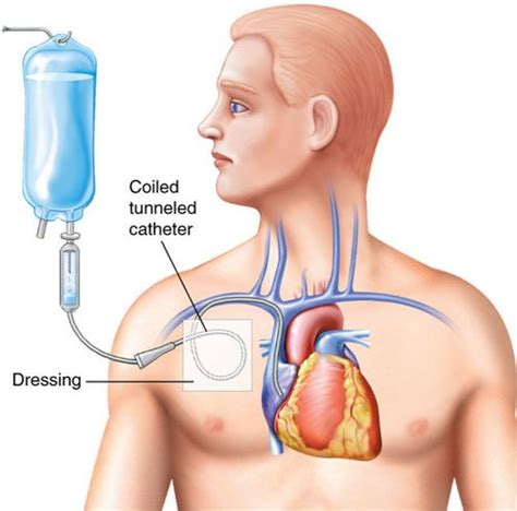 Tunneled Central Line Catheter | Hot Sex Picture