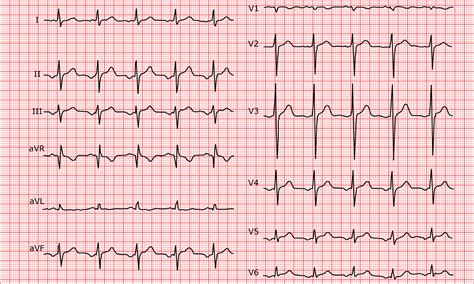 Ectopic Atrial Tach