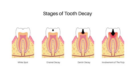 5 Stages Of Tooth Decay