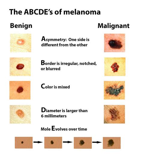 “So I have this mole…" How to identify skin cancer and how to prevent ...