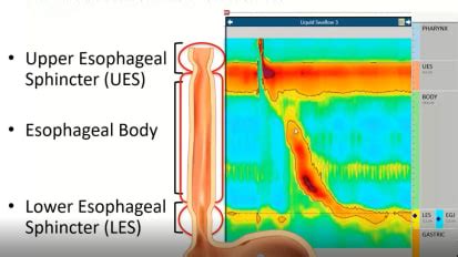 Esophageal Manometry - Diversatek University