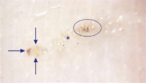 Scabies Mite Microscope