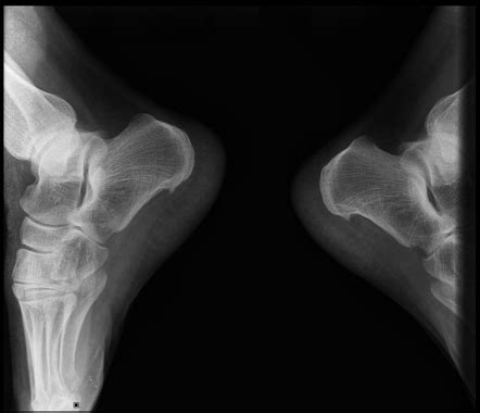 Plantar calcaneal spur | Radiology Reference Article | Radiopaedia.org