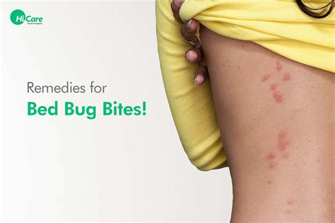 Top 10 Bed Bug Bites Treatment | HiCare