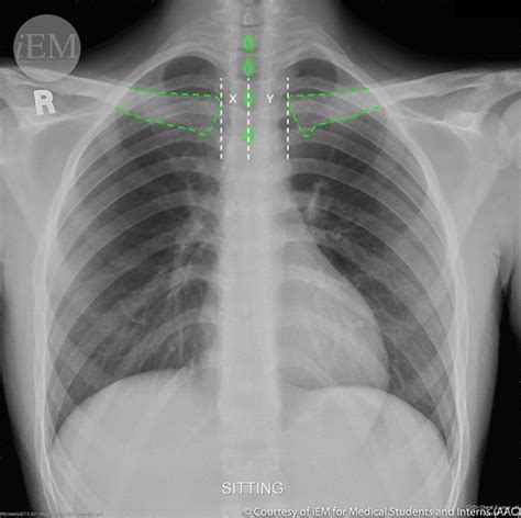 How to read chest x-rays – International Emergency Medicine Education ...