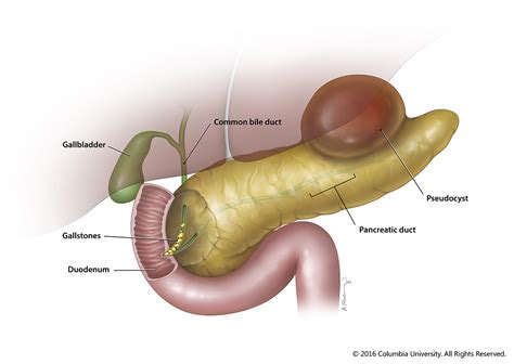 Pancreatitis