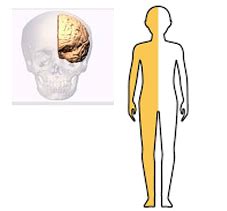 Hemiplegia - Understanding Risks, Symptoms and Management