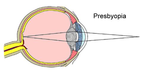Presbyopia