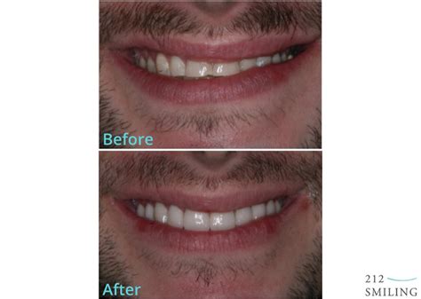 Teeth Before And After Veneers