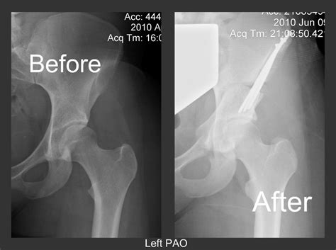 Periacetabular Osteotomy (PAO) ~ Living with Ehlers Danlos Syndrome