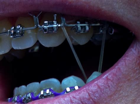 What Do Rubber Bands Do on Braces? - OC Dental Center