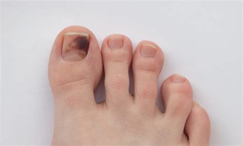 Melanoma under toenail pictures: black spot, nail melanoma pictures, toenail melanoma pictures ...