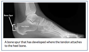 Achilles Tendinitis | BoulderCentre for Orthopedics & Spine